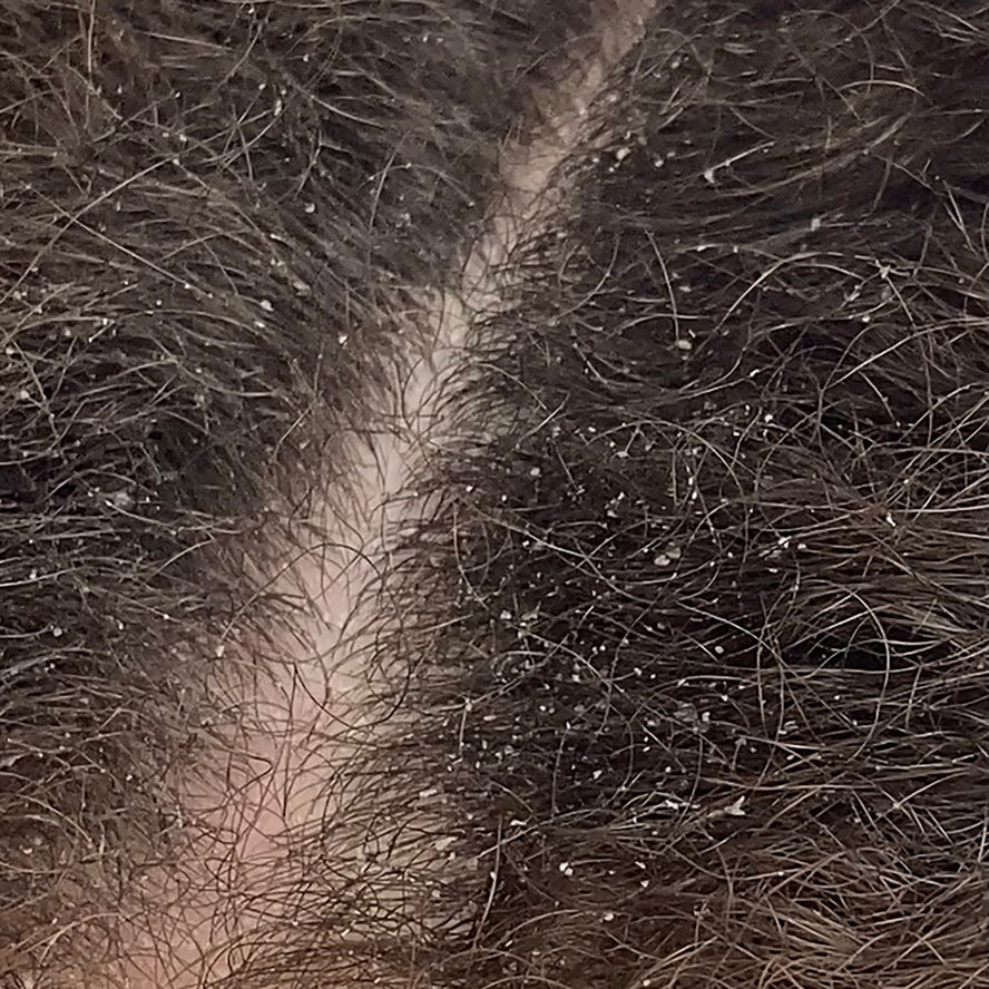 5 Common Myths About Dandruff