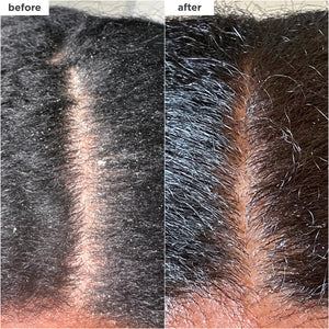 Scalp Revival™ MegaStrength+ Dandruff Relief Shampoo Charcoal + AHA/BHA with Salicylic Acid 3%